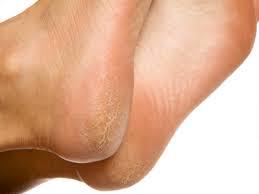 what causes cracked heels and what are the symptoms