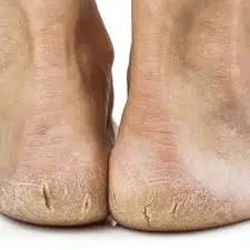Common causes of painful cracked heels.