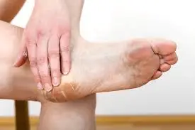 excessive dry feet