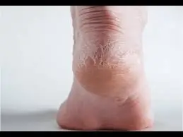 Painful cracked heels can be a result of letting feet become too dry.