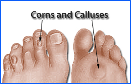 corns_and_calluses