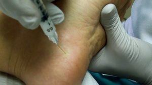Corticosteroid Injections Plantar Fasciitis