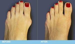 bunions-surgery-before-after