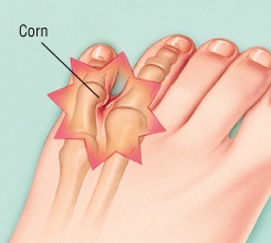 corn surgery